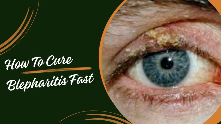 How To Cure Blepharitis Fast